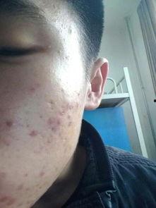 扎粉刺视频,扎粉刺视频全解析